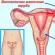 Oophoritis.  Inflammation of the ovaries.  Salpingoophoritis Adnexitis mcb 10 international classification of diseases